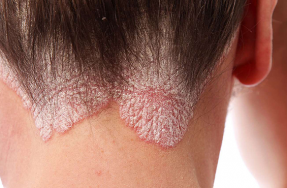 Treatment-of-psoriasis