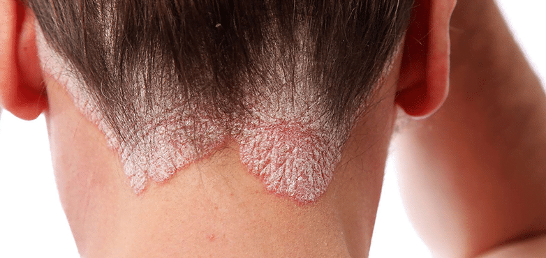 Treatment-of-psoriasis